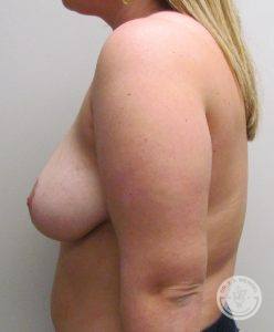 Nashville woman after Breast Reduction