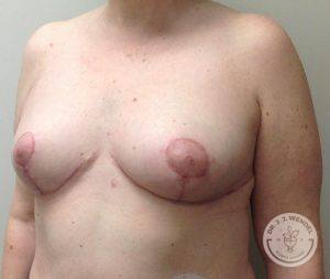 Breast lift Nashville TN