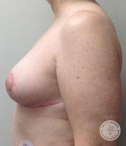 Breast lift Nashville TN