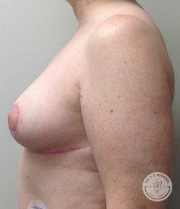 Breast lift Nashville TN