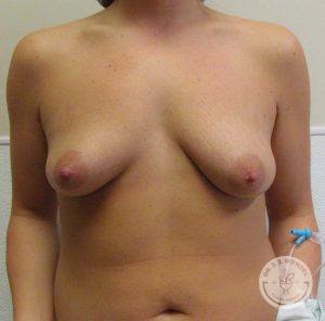 Breast symmetry Nashville