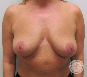 Breast Lift Surgery