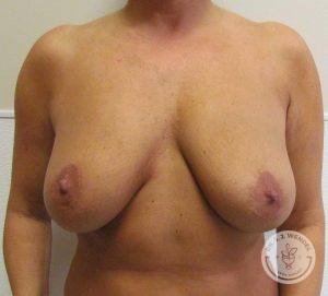 close up view of a woman's breasts before receiving a breast lift