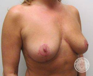 Breast Lift Surgery