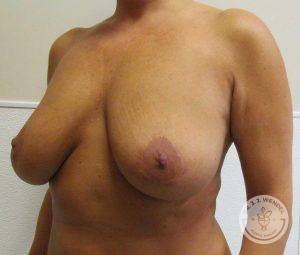 Breast Lift Surgery