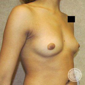 Breast implants Nashville