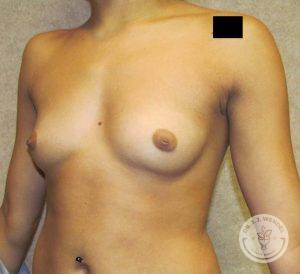 Breast implants Nashville