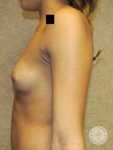 Breast implants Nashville