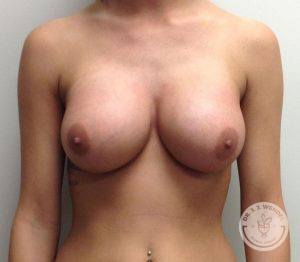 Breast Implants Nashville