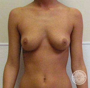 Breast Implants Nashville