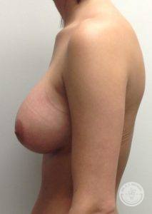Breast Implants Nashville