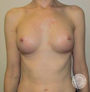 Breast implants Nashville TN