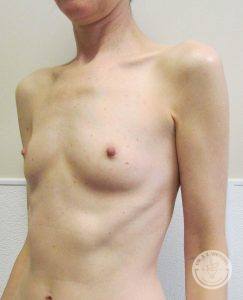 Breast implants Nashville TN