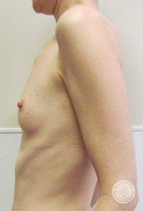 Breast implants Nashville TN