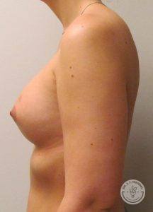 After breast implants Nashville TN