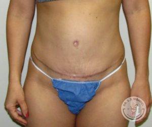 Woman before after tummy tuck Nashville TN