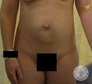 Woman before after tummy tuck Nashville TN