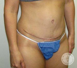 Woman before after tummy tuck Nashville TN