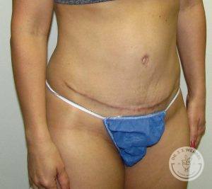 Woman before after tummy tuck Nashville TN