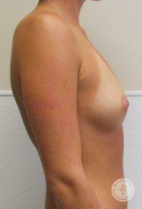Before breast implant surgery
