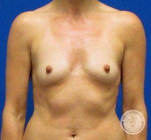 Woman before after Silicone breast implants Nashville TN