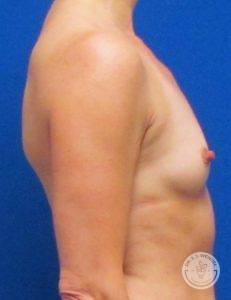 Woman before after Silicone breast implants Nashville TN