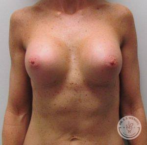 Woman silicone breast implants Nashville