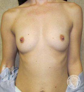 Woman silicone breast implants Nashville