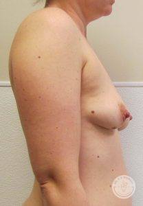 Breast augmentation Nashville Tennessee