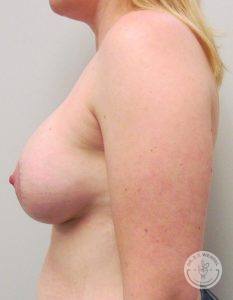 Breast augmentation Nashville Tennessee