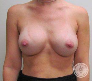 Woman silicone breast implants Nashville