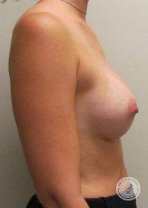 Woman silicone breast implants Nashville