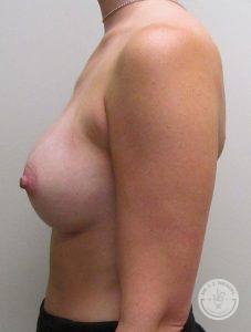 Woman silicone breast implants Nashville