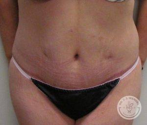 Woman before after tummy tuck Nashville TN