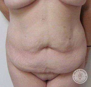 Woman before after tummy tuck Nashville TN