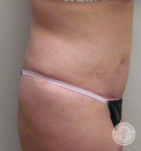 Woman before after tummy tuck Nashville TN