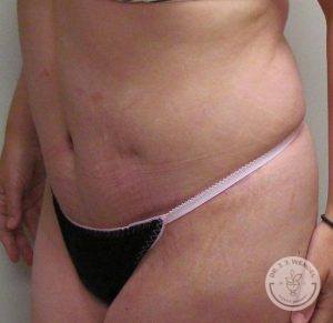 Woman before after tummy tuck Nashville TN