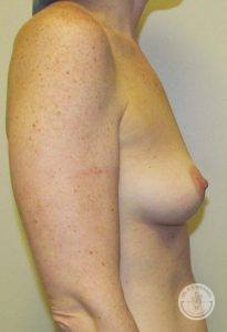 Silicone breast implant surgery Nashville Tennessee