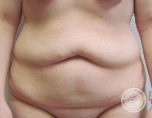 Woman before after Tummy Tuck Nashville TN