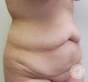 Woman before after Tummy Tuck Nashville TN