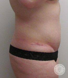Woman before after Tummy Tuck Nashville TN