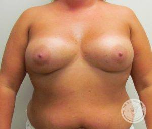 Silicone breast implant surgery Nashville Tennessee