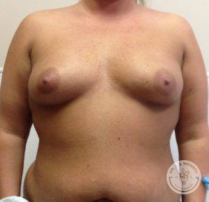 Silicone breast implant surgery Nashville Tennessee