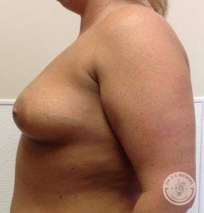 Silicone breast implant surgery Nashville Tennessee