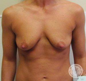 Breast augmentation with lift