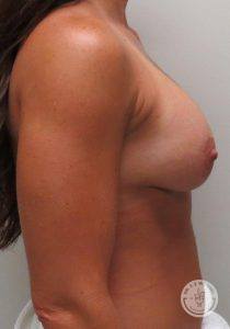 Breast augmentation with lift