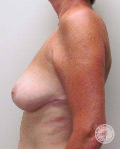 Breast Lift Surgery Nashville Tennessee