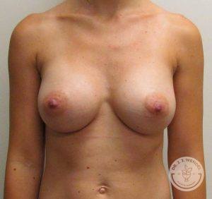 Silicone breast implant surgery Nashville Tennessee