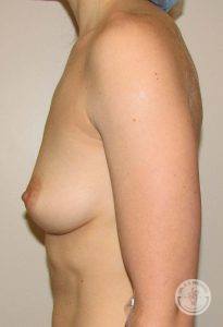 Silicone breast implant surgery Nashville Tennessee