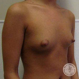 Saline Breast Implants